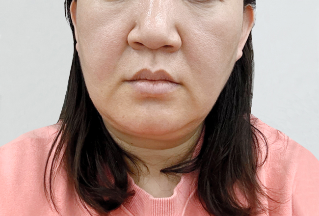 before 이미지